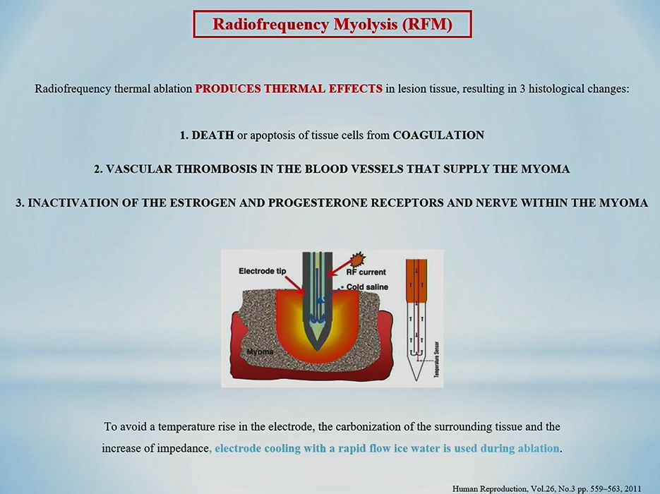 Fibromatosi uterina: ruolo della miolisi in radiofrequenza